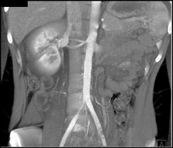 Renal Laceration - CTisus CT Scan