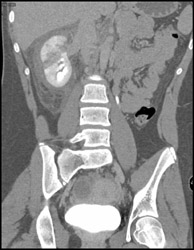 Renal Laceration - CTisus CT Scan