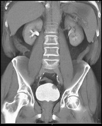 Bladder Tumor - CTisus CT Scan