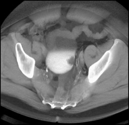 Bladder Cancer - CTisus CT Scan