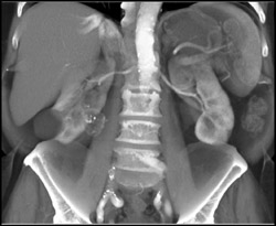 Right Renal Cell Caricnoma - CTisus CT Scan