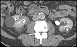 Right Renal Cell Caricnoma- Calcifications - CTisus CT Scan