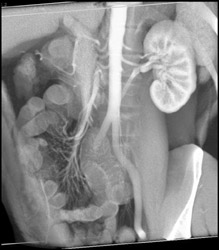 Retroaortic Renal Vein - CTisus CT Scan