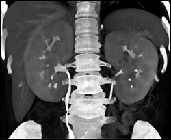 Ct Urogram in Large Kidneys - CTisus CT Scan