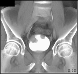 Multiple Bladder Cancers - CTisus CT Scan