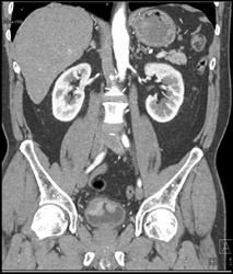 Multiple Bladder Tumors - CTisus CT Scan