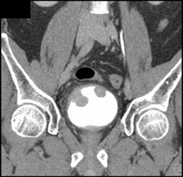 Multiple Bladder Cancers- Transitional Cell Cancer (TCC) - CTisus CT Scan