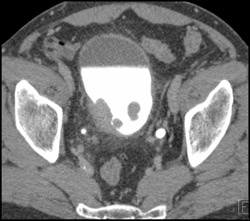 Bladder Cancer Grows Through Muscularis - CTisus CT Scan