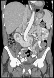 3 Kidneys - CTisus CT Scan