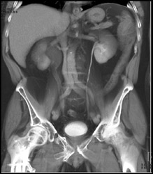 Ct Urogram With Tumor in Right Distal Ureter - CTisus CT Scan