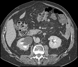 Narrowing of Right Distal Ureter - CTisus CT Scan