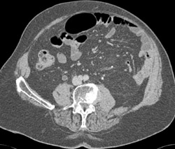 Transitional Cell Cancer (TCC) of Ureter - CTisus CT Scan