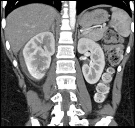 Renal Laceration - CTisus CT Scan