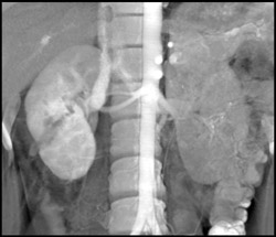 Renal Laceration - CTisus CT Scan