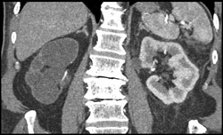 Hydronephrotic Sac Right Kidney - CTisus CT Scan