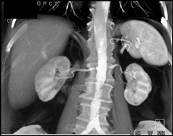 Stenosis Right Renal Artery - CTisus CT Scan