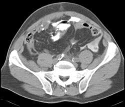 Leak From Neobladder - CTisus CT Scan