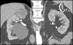 Renal Cell Carcinoma - CTisus CT Scan