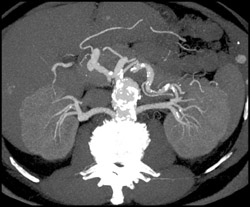 MIP of Renal Artery - CTisus CT Scan