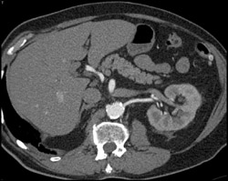 2 Left Renal Arteries - CTisus CT Scan