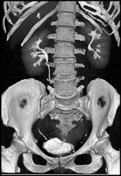 Normal CT Urogram - CTisus CT Scan