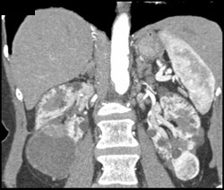 Renal Carcinomas - CTisus CT Scan