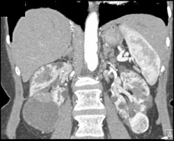 Vascular Renal Carcinomas - CTisus CT Scan