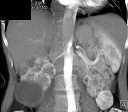 Bilateral Renal Carcinomas - CTisus CT Scan