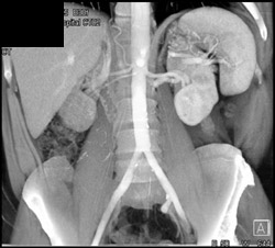 Multiple Renal Arteries - CTisus CT Scan