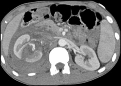 Renal Laceration With Active Extravasation - CTisus CT Scan