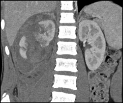 Renal Laceration - CTisus CT Scan