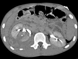 Leak From Renal Pelvis on Delayed Images - CTisus CT Scan