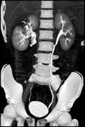 Renal Laceration and Contrast Extravasation - CTisus CT Scan