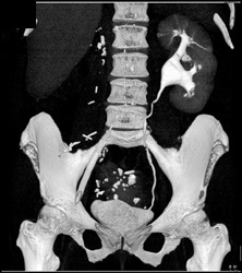 Prior Right Nephrectomy - CTisus CT Scan