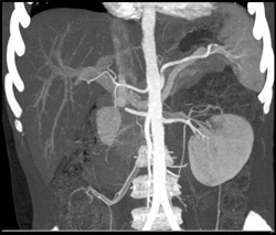 Renal Laceration to Upper Pole - CTisus CT Scan