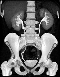 Normal CT Urogram - CTisus CT Scan