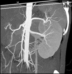 Prominent Left Gonadal Vein - CTisus CT Scan