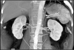 Multiple Renal Arteries - CTisus CT Scan