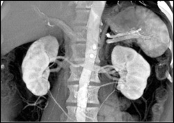 Multiple Renal Arteries - CTisus CT Scan