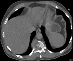 Renal Cell Carcinoma With Bone Metastases - CTisus CT Scan