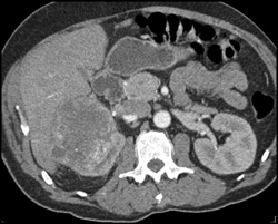 Renal Cell Carcinoma - CTisus CT Scan