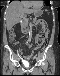 Pyelosinus Fat and Neobladder - CTisus CT Scan