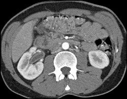 Thickened Endothelium on Right - CTisus CT Scan