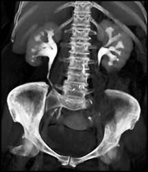 Normal CT Urogram - CTisus CT Scan