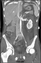 Renal Laceration and Blood - CTisus CT Scan