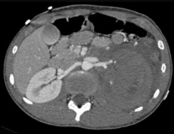 Renal Laceration - CTisus CT Scan