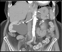 Ureteropelvic Junction (UPJ) on Right - CTisus CT Scan