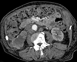 Transitional Cell Cancer (TCC) of Right Renal Pelvis - CTisus CT Scan