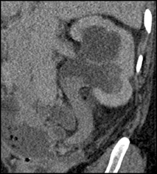 Transitional Cell Cancer (TCC) of Renal Pelvis - CTisus CT Scan