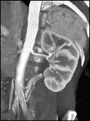 Circumaortic Renal Vein and Multiple Renal Arteries - CTisus CT Scan